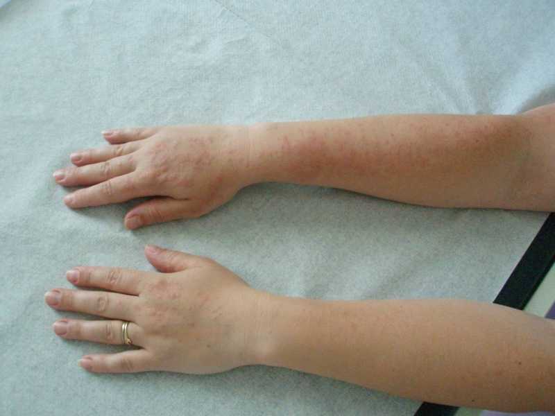 Polimorfna dermatoza